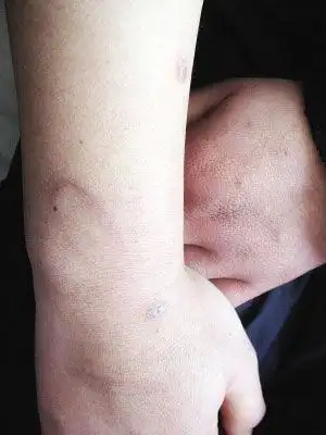 打工妹遭女老板殴打被螺丝刀戳得满背是血图