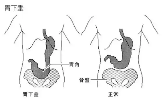 胃下垂 会导致 腹痛 ,内脏下垂等