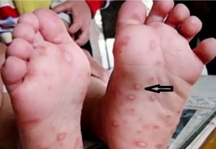 预防手足口病,保障孩子健康