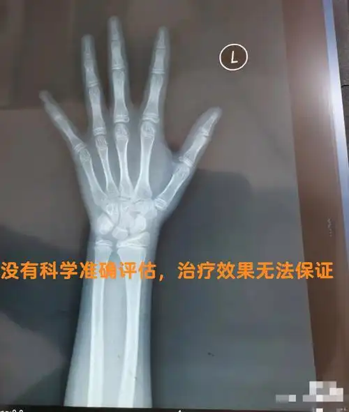 没看科学准确骨龄评估治疗效果无法保证