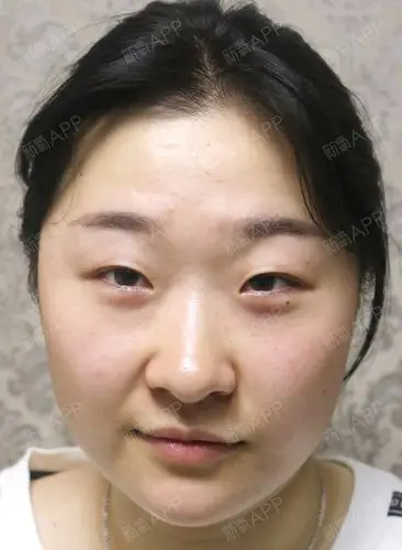 一直觉得在自己的眼睛好小,一笑就成一条缝,总想着把_圈子-新氧美容