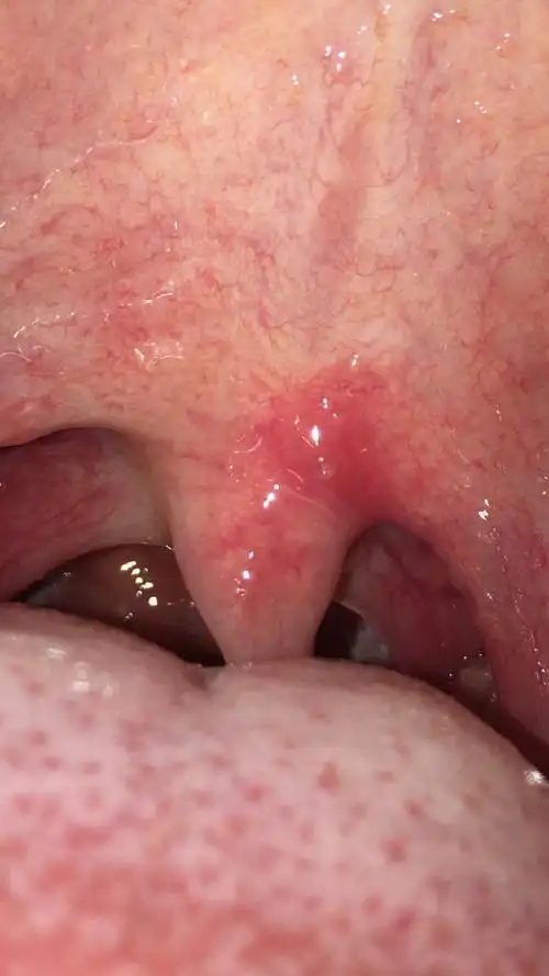 吃快卖榨菜肉丝,吃一半突然感觉口腔很痛,照片拍下来