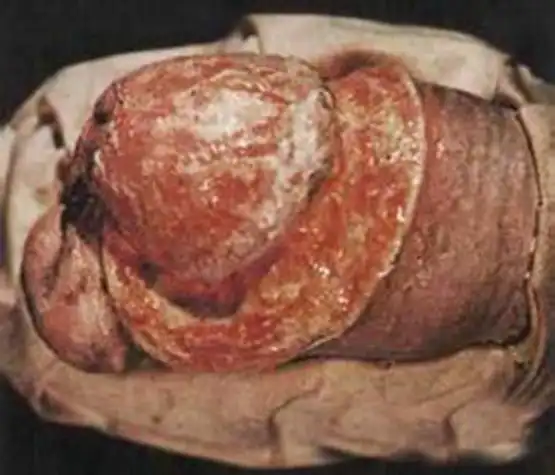 在游泳池会传染梅毒吗梅毒的4大传播途径早了解早防范