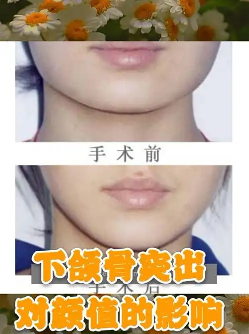 下巴前突被大家称为地包天也就是医学上所说的下颌骨前突