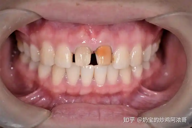 全瓷牙or烤瓷牙?牙冠该如何选择