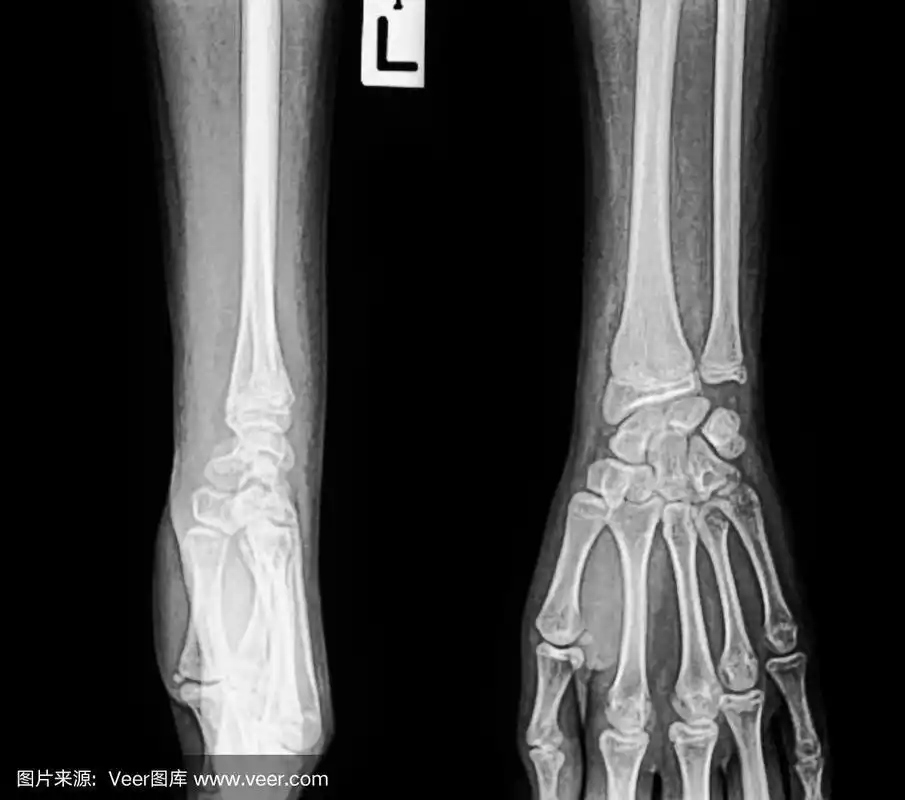手腕,桡骨,影片,x光,健康保健