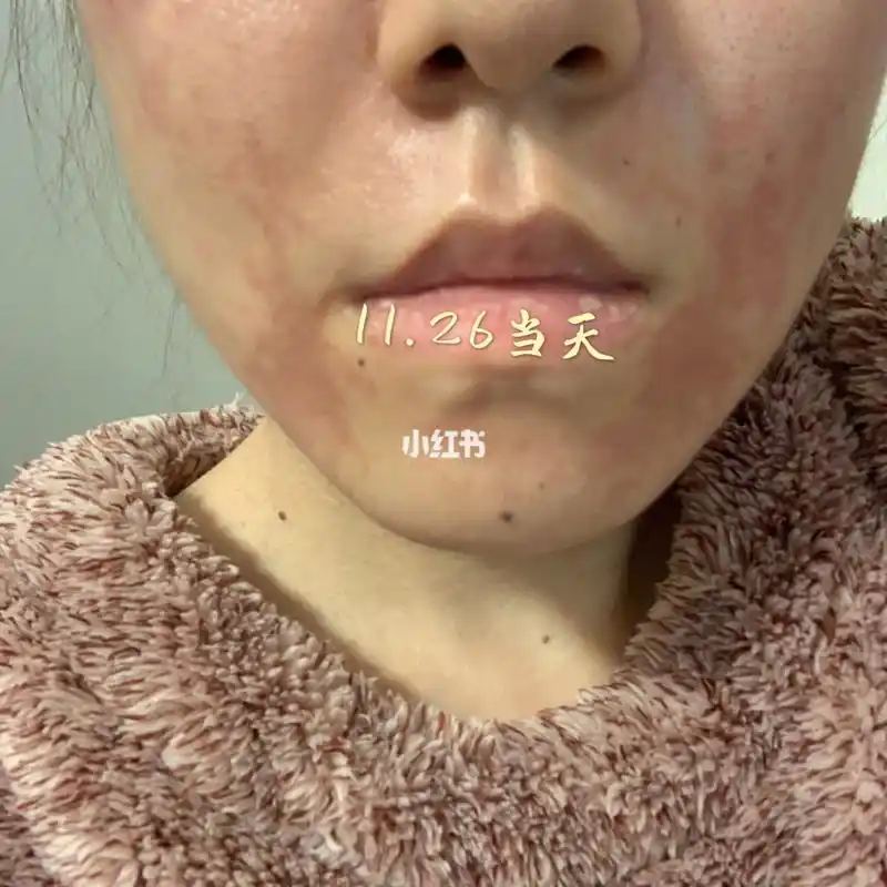 麻药过敏,麻药灼伤,真是漫长的一周