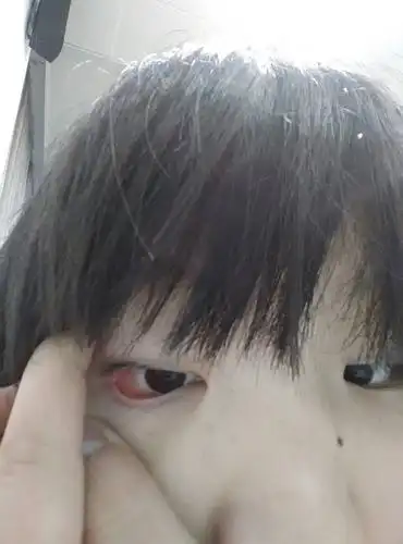 眼睛红肿,眼角像是起了水泡,怎么回事?该怎么办?