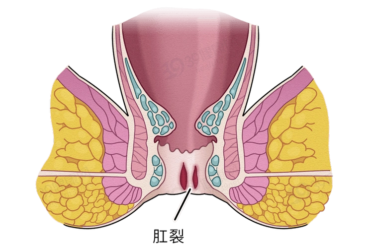 西安马应龙肛肠医院:排便疼痛出血,警惕肛裂来袭_肛门_裂口_皮肤