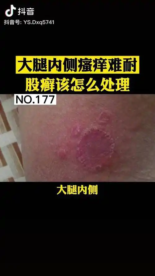 男性大腿内侧瘙痒难耐股癣该怎么处理呢皮肤病