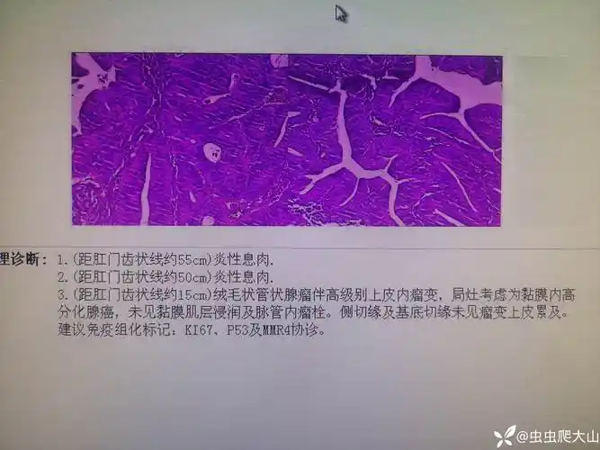 绒毛状管状腺瘤伴高级别瘤变局灶高分化腺癌镜下切除治疗一例