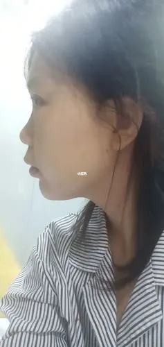 膨体下巴这样是不是做废了_美妆_医美_整容_美妆_医美整形