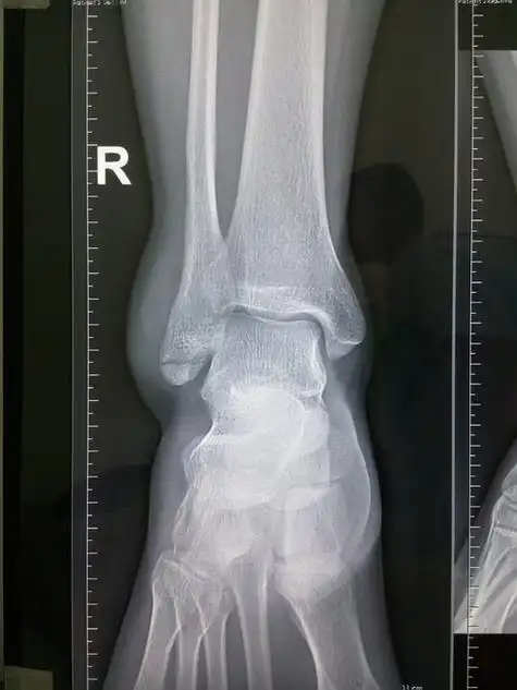 【求助】【附图】外踝骨折多长时间能好