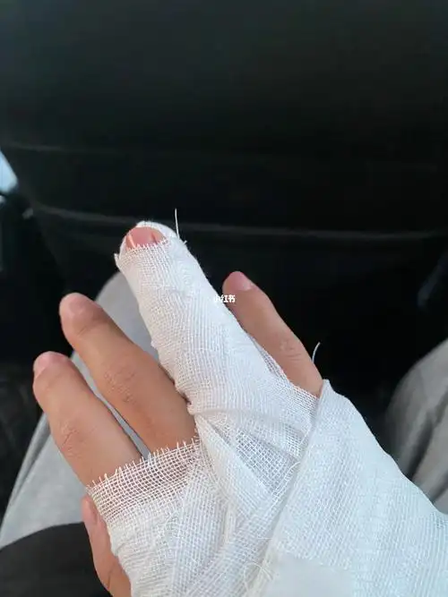 手指骨折,一个月后才去复查,发现错位了,可能要手术,心理压力