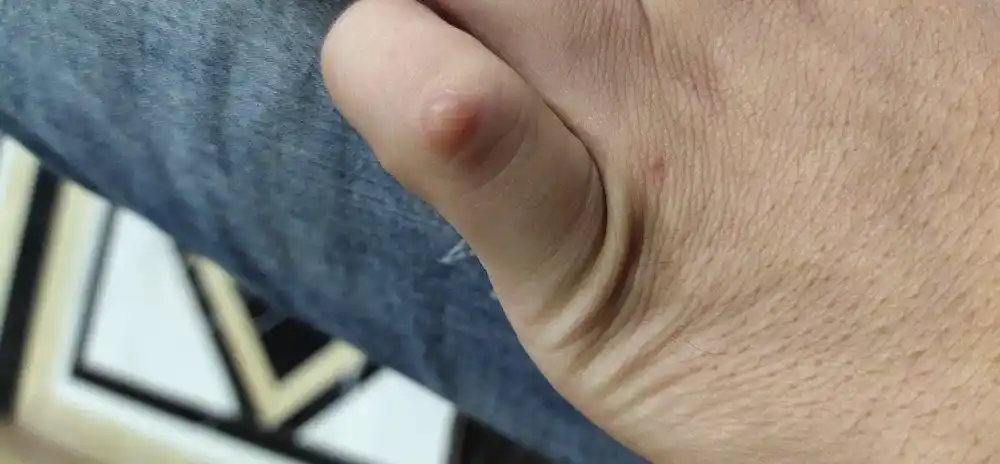 手关节长了个包,谁知道什么原因?
