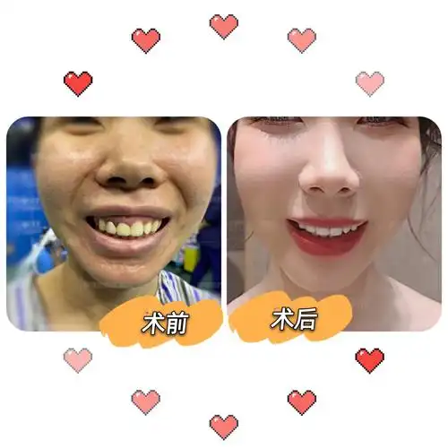 【正颌手术案例分享】凸嘴露龈笑术前术后对比,术后她绽放自信笑容.