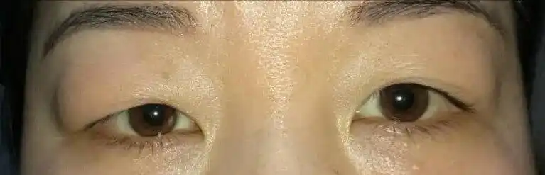 眼睑肿胀疾病之 泪腺脱垂. - 好大夫在线