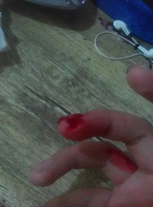 切水果时 手指 切掉一块肉 流血流了10分钟 现在这种情况该怎么包扎