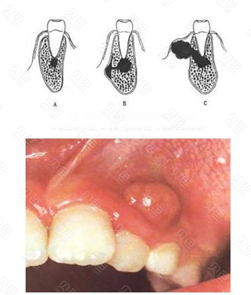 牙龈上长脓包,竟然是根管治疗没做好引起的祸