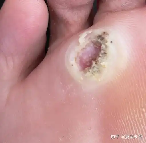 跖疣斗争记(醋精) - 知乎