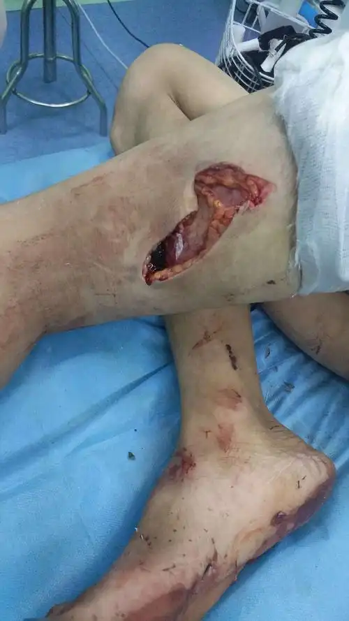 镇平县有位老乡大腿股动脉被镰刀割断啦,患者正在大出血,家