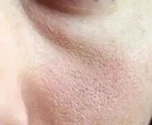 昕芙康:听说你毛孔大到可以放芝麻,该怎么办?