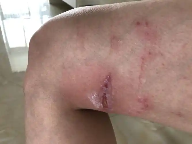 腿突然就溃烂了,医生也说不出个所以然了,我到底怎么了
