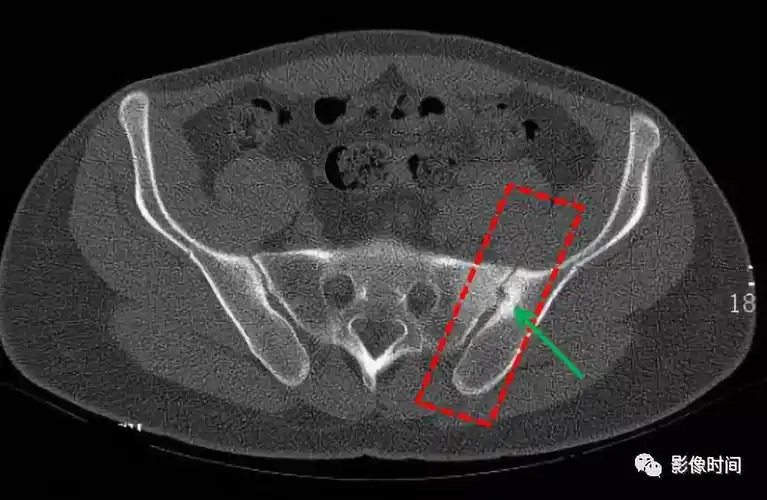 强直性脊柱炎的影像