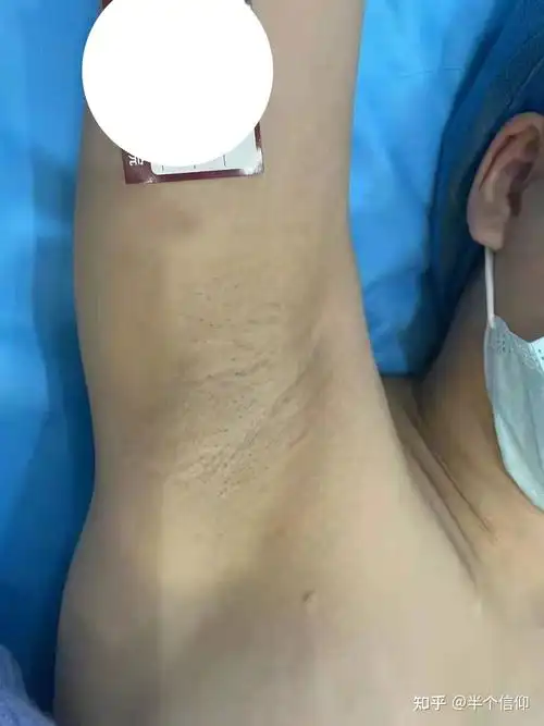 腋臭微创手术恢复