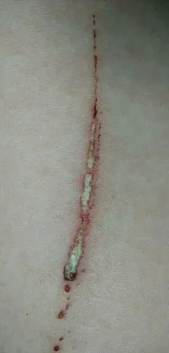 你好,前几天不小心被刀子割伤了,破了层皮,用酒精