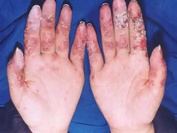 亚急性皮肤型红斑狼疮图片