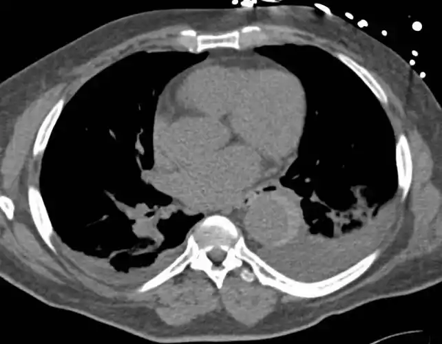 主动脉夹层ct平扫影像:主动脉双腔征,血胸