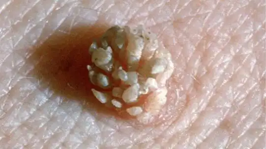 肛门尖锐湿疣有可能只有一个吗_肛门尖锐湿疣_肛门尖锐湿疣