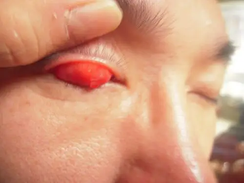 上眼结膜赘生物见照片如何处理