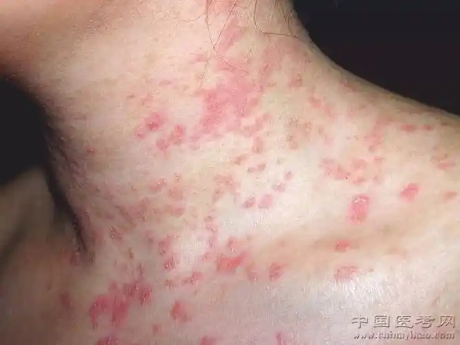 史上最全的皮肤病图谱来了(修订版)!