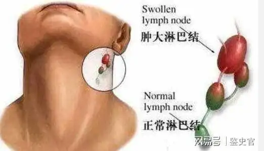 淋巴结肿大很常见,应多注意这几种情况,或是身体发出的"信号"|出血|淋