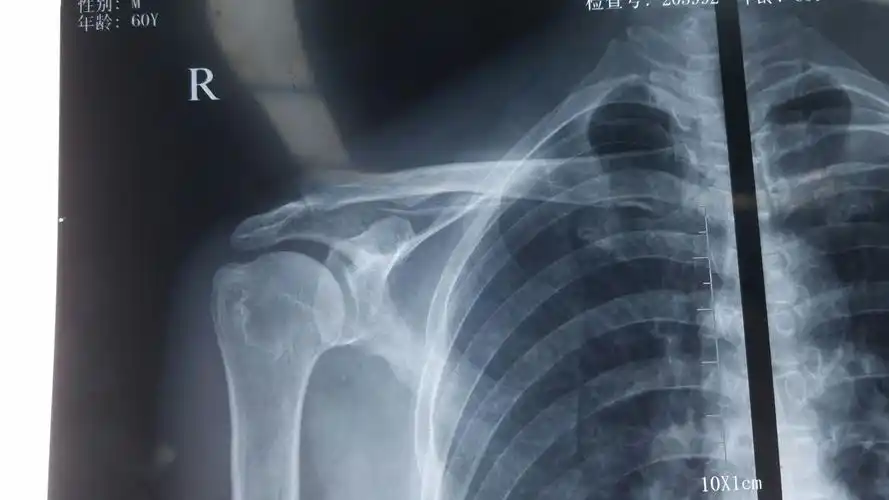 肩关节镜下肩峰成行,肩袖修补术