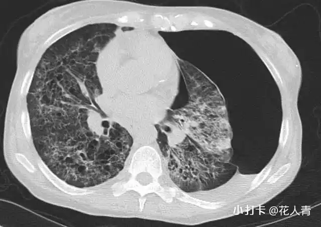 胸片示弥漫性对称性网点状间质性阴影,伴左侧自发性气胸.