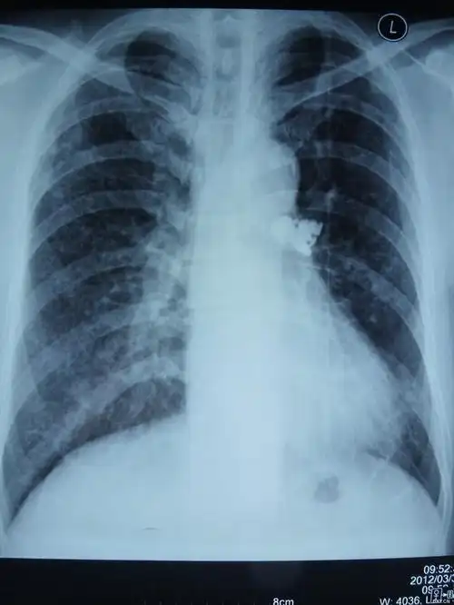 【影像读片】一张正位胸片,看看考虑什么(结果已公布)