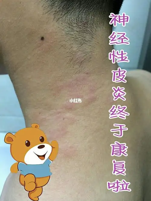 越抓越痒脖子后面长了像癣一样的东西神经性皮炎皮炎和癣的区别图片