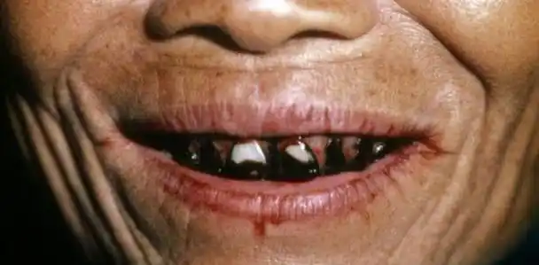 图注:嚼食槟榔导致的牙齿变色槟榔致癌的原因是它含有大量的槟榔素,这