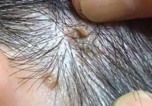 瘊子冷冻后水泡弄破会传染吗