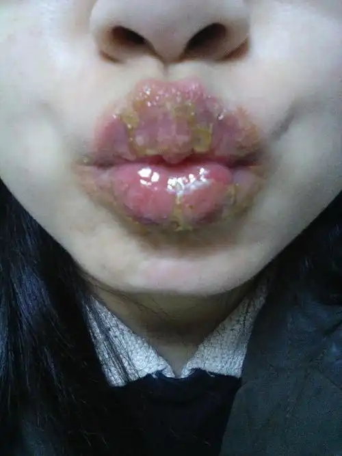 患唇炎两年进一月突然严重求救