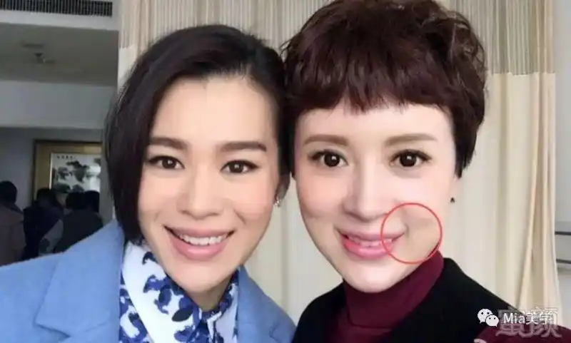 笑起来嘴角有两道纹,但又不是法令纹,究竟是怎么回事?