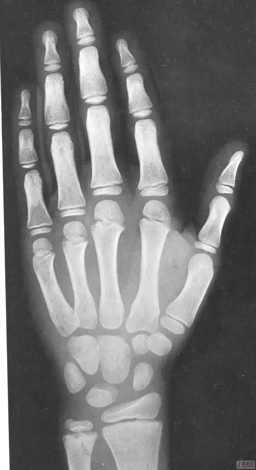 中国儿童标准骨龄片