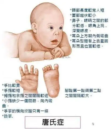 小头症有特殊面容吗