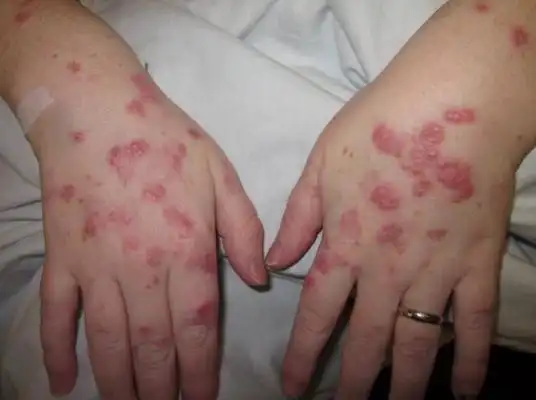 蚂蚁咬人后症状图片45