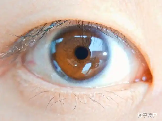 虹膜异色症是种怎样的体验