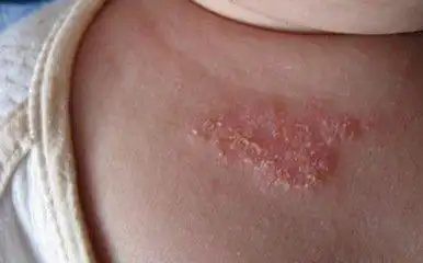 秋冬宝宝皮肤干燥易得湿疹这10个注意事项你不可不知