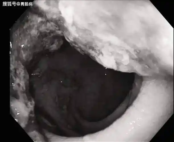 今年44岁的常先生是因为最近半年,持续腹痛,大便不成型,伴粘液便,偶尔